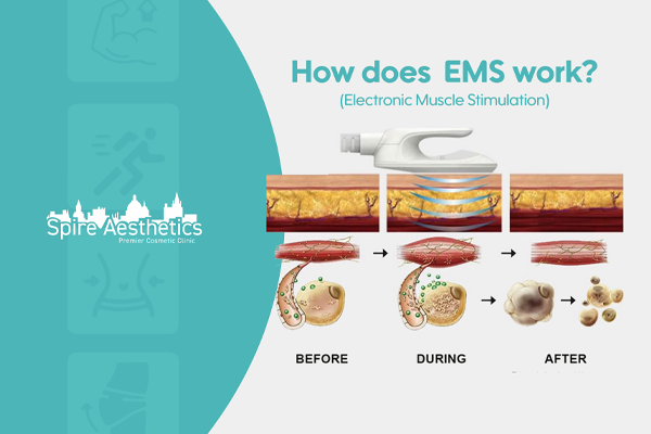 EMS treatment for post pregnancy weight loss treatment Bicester