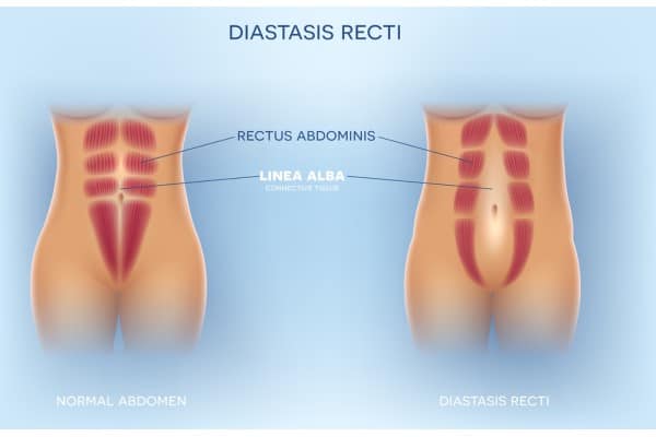 What Non-Surgical Options Are Available for Diastasis Recti Bicester?