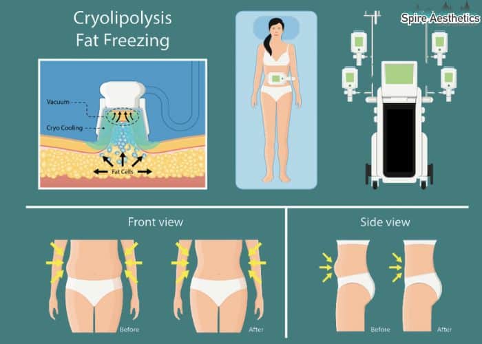Image of diet and fat freezing combined for best results for Spire Aesthetics Bicester