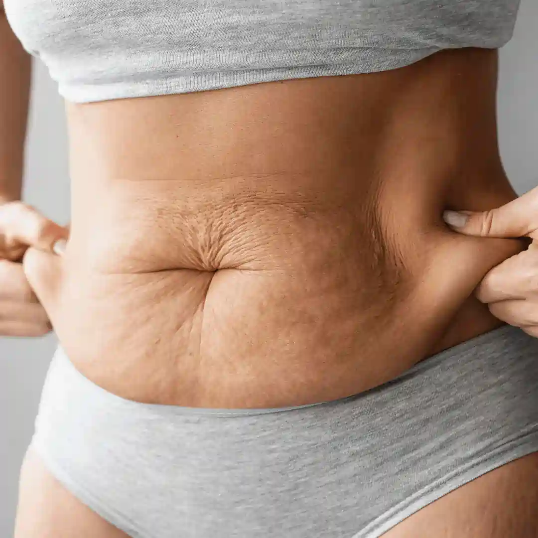 Is It Normal to Have Loose Skin After Pregnancy Bicester?