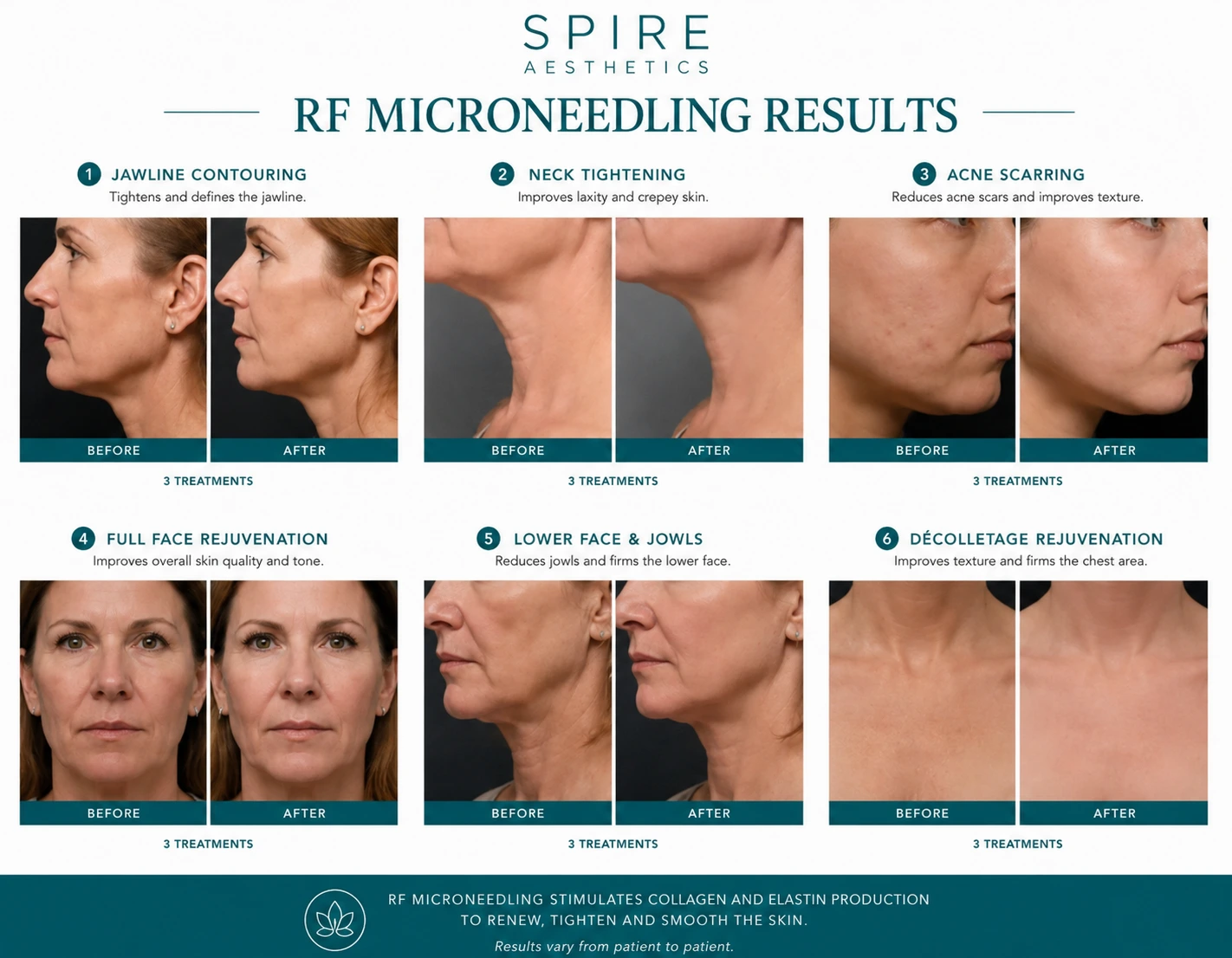 RF Microneedling Skin tightening Bicester results