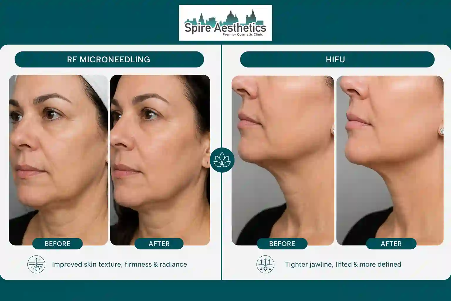 Can RF Microneedling and HIFU Be Combined Bicester?