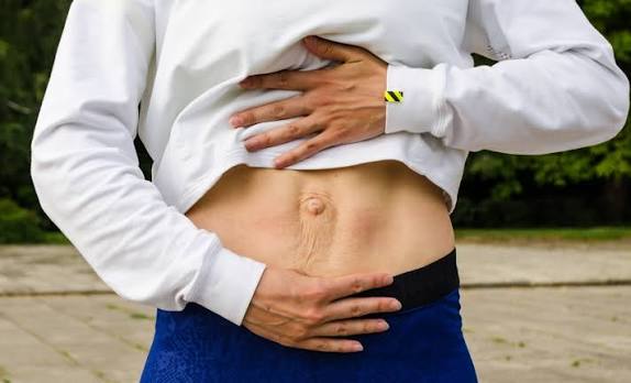 When Could Diastasis Recti Be the Missing Piece of the Puzzle Bicester?