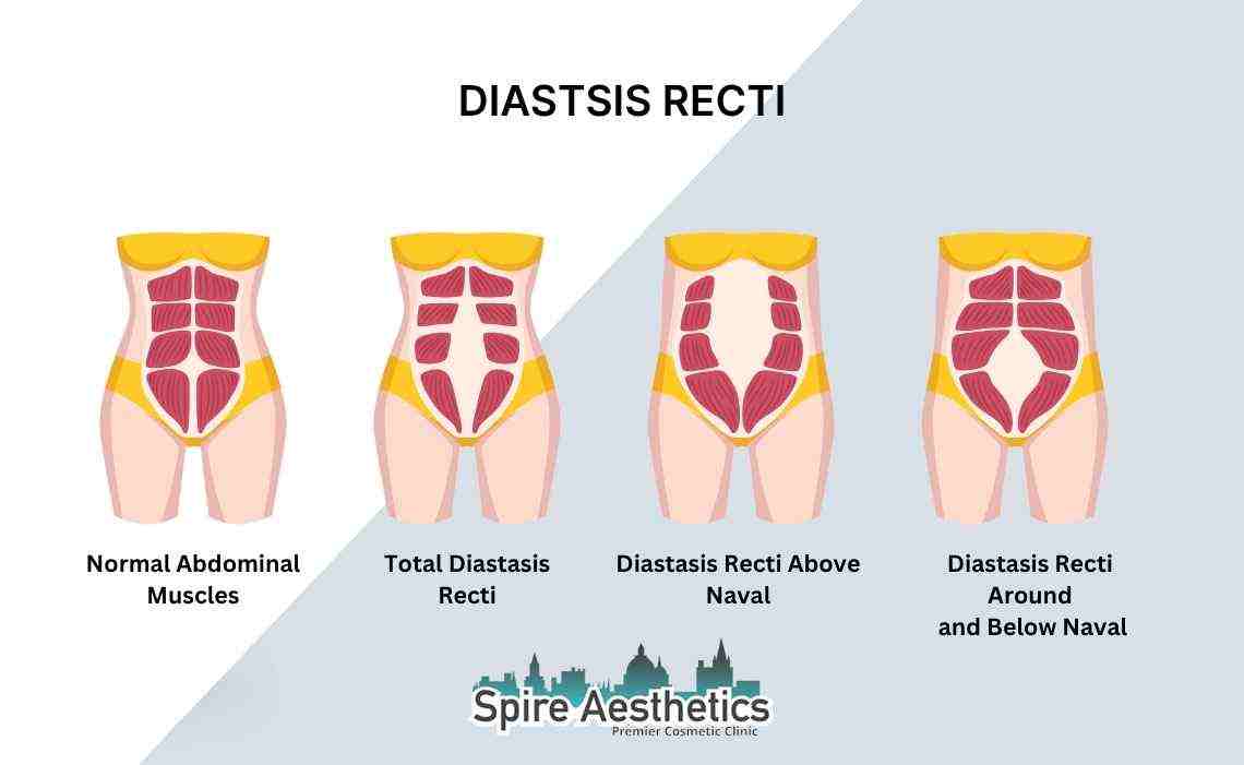 Is Non-Surgical Diastasis Recti Treatment Right for You? Common Concerns Answered Bicester
